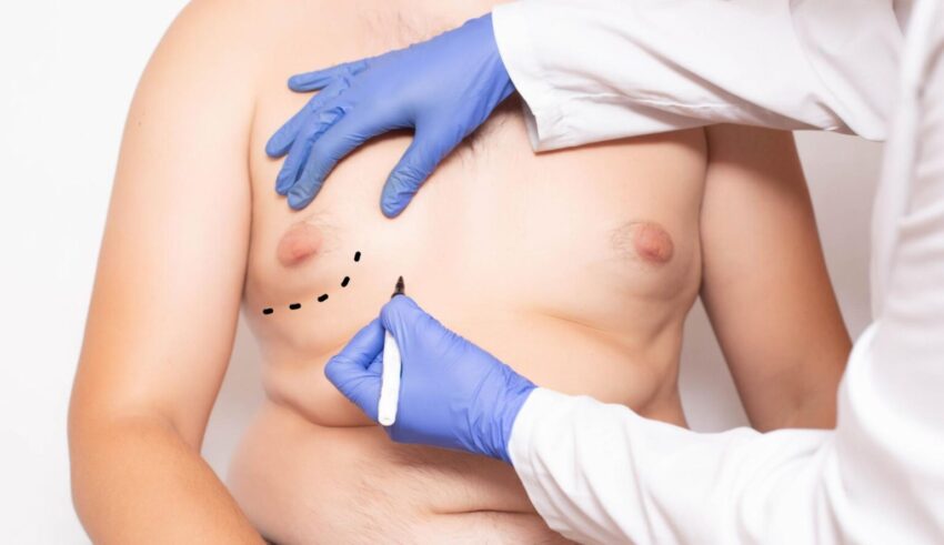 Gynecomastia Surgery